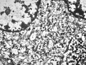 F, 45y. | carcinoid … liver metastasis